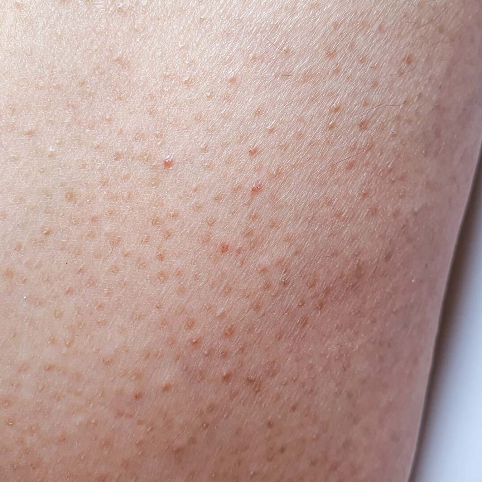 Keratosis Pilaris Kristal Skin & Laser Clinic