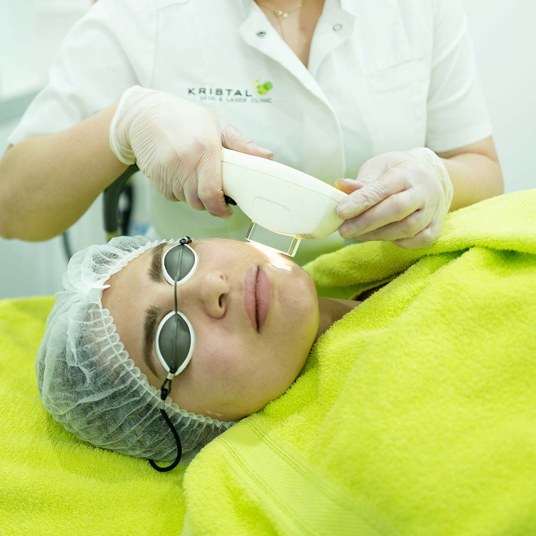 IPL behandeling Kristal Skin & Laser Clinic